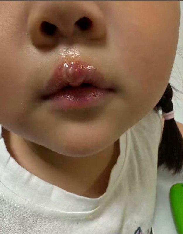 女童被幼儿园老师用热熔胶烫嘴虐待近日，有江苏徐州丰县的幼儿家长通过社交平台反映称，孩子在丰县机关第二幼儿园上学时，遭到老师用热熔胶故意烫伤嘴唇，并遭到虐待体罚，此事引发关注